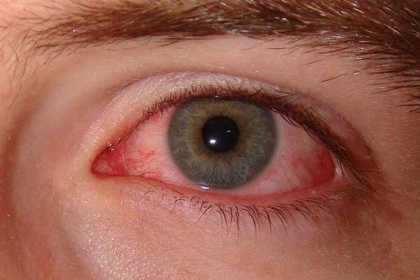 انواع قطره چشم برای استریل و درمان بیماری های چشمی